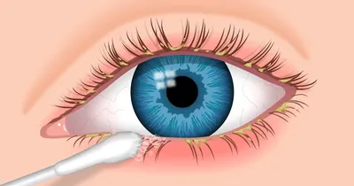 Воспаление век (блефарит) - «ДВЦОЗ» — Дальневосточный центр охраны зрения