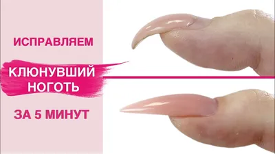 Клюющие ногти – что это такое, виды, причины возникновения и методы  исправления