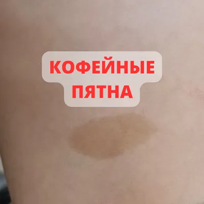 Кофейные пятна на коже фото фото