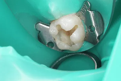Коффердам в стоматологии - безопасность и защита пациента