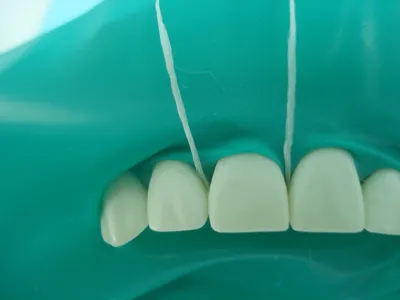 Коффердам в стоматологии – что такое и для чего нужен?