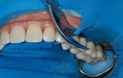 Коффердам что такое, зачем в стоматологии используется