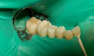 Коффердам - гарант качества и безопасности в стоматологической клинике  «Доминанта»