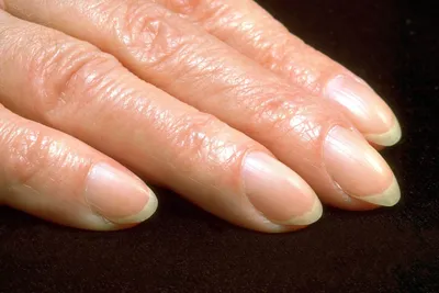PODOLOGLife - 😱Койлонихия . Койлонихия – так называют одну из самых  распространенных заболеваний ногтей. Разновидность дистрофии ногтей. . В  простонародье данное заболевание носит название ложкообразный ноготь, так  как ногти деформируются и становятся
