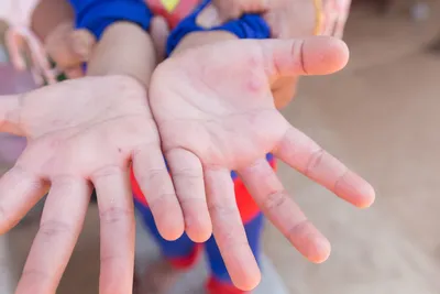 энтеровирусная мурашка на руке на теле детского вируса коксаки Стоковое  Фото - изображение насчитывающей опасность, кожа: 234194214