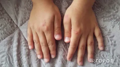 Фото: после вируса Коксаки может сойти кожа и отпасть ногти