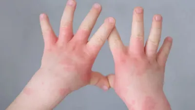Онихолизис ногтей: виды, причины, симптомы и лечение. Как связаны  онихолизис и гель-лак?