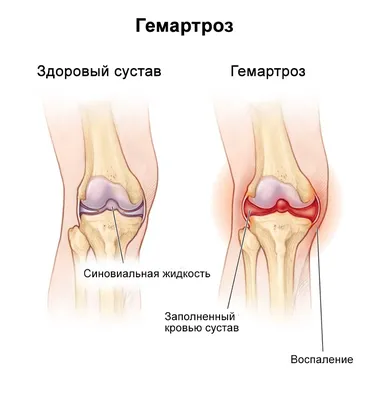 Тендинит коленного сустава: симптомы, лечение и разновидности заболевания