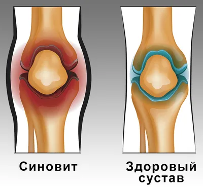 Боль в коленном суставе в Москве | Клиника «Ваш Доктор»