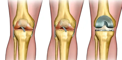 Коленный сустав — Травмаорто