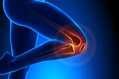 Эндопротезирование коленного сустава, замена коленного сустава