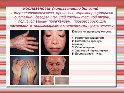 Лечение дерматомиозита в Киеве — Derma.ua