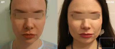Как избавиться от шрамов и рубцов на лице и теле | Клиника “Elevans”