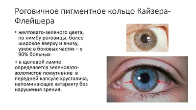 Файл:KF ring and Sunflower cataract.jpg — Википедия