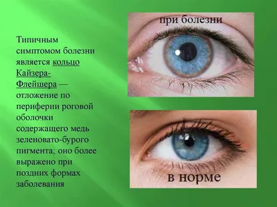 Медные люди: что важно знать о болезни Вильсона-Коновалова: статья  врача-гастроэнтеролога, гепатолога Тэи Розиной — Редкий журнал