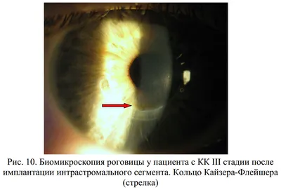 ООО \"НПМЦ \"Инновации и Здоровье\" - На фотографии видно кольцо Кайзера -  Флейшера (отложение меди по периферии радужной оболочки). Чаще всего оно  встречается при прогрессирующем заболевании - болезни Вильсона -  Коновалова. Любой