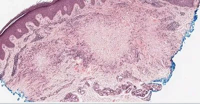 Combination treatment of disseminated granuloma annulare - Karamova -  Vestnik dermatologii i venerologii