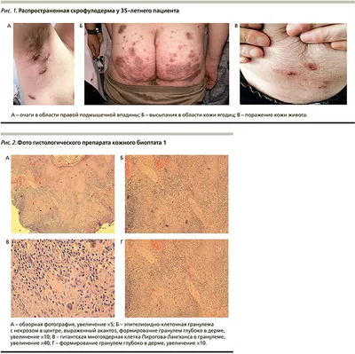 PDF) Clinical and pathological changes in the skin with granuloma annulare