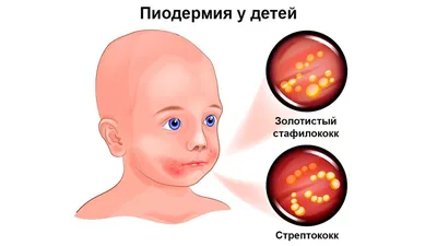 Лишай: симптомы, виды, причины и лечение заболевания.