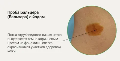 Стригущий лишай (tinea corporis): лечение