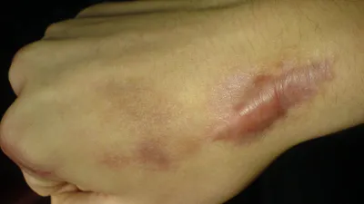 Человеческая нога с грануломой кольцевой или розового лишайником. Кожное  заболевание. Стоковое Фото - изображение насчитывающей взорвать,  аллергически: 171455942
