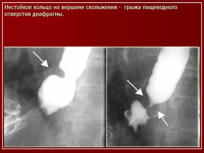 ПС. Пищевод. Набор изображений № 1. Норма. Ахалазия пищевода. ГПОД.  Дивертикулы. Пищевод Барретта. Инфекционные эзофагиты. Кольцо Шацкого.  Другое. Изображения из коллекции Стенфордского университета. + | Портал  радиологов