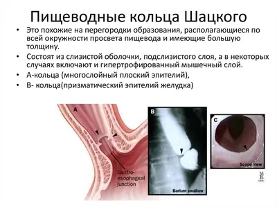 ПС. Пищевод. Набор изображений № 1. Норма. Ахалазия пищевода. ГПОД.  Дивертикулы. Пищевод Барретта. Инфекционные эзофагиты. Кольцо Шацкого.  Другое. Изображения из коллекции Стенфордского университета. + | Портал  радиологов