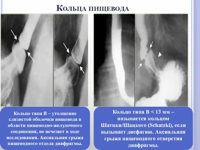 КОЛЬЦО ШАЦКОГО КАК СИМПТОМ ГАСТРОЭЗОФАГЕАЛЬНОЙ РЕФЛЮКСНОЙ БОЛЕЗНИ – тема  научной статьи по клинической медицине читайте бесплатно текст  научно-исследовательской работы в электронной библиотеке КиберЛенинка