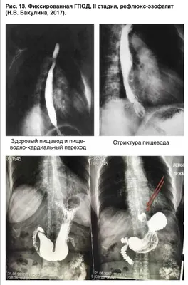 Кольцо Шацкого как симптом гастроэзофагеальной рефлюксной болезни