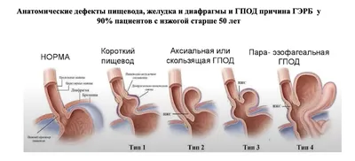 Гастроэзофагеальная рефлюксная болезнь — Reclin