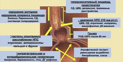 Гастроэзофагеальная рефлюксная болезнь — Reclin