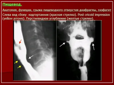 ПС. Пищевод. Набор изображений № 1. Норма. Ахалазия пищевода. ГПОД.  Дивертикулы. Пищевод Барретта. Инфекционные эзофагиты. Кольцо Шацкого.  Другое. Изображения из коллекции Стенфордского университета. + | Портал  радиологов