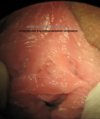 Atlas of visual inspection of the cervix with acetic acid for screening,  triage, and assessment for treatment