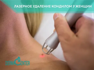 Качественное удаление кондилом в Минске, цена - Клиника в Уручье