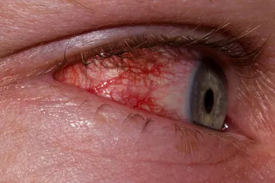 Неожиданный симптом в глазах указывает на «омикрон»