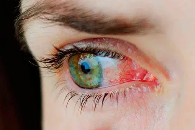 Клиника Кудрет Коз Бишкек - Конъюнктива содержит маленькие кровеносные  сосуды. При воспалении эти сосуды расширяются, и глаз краснеет.  Конъюнктивит при отсутствии своевременного лечения может дать осложнения,  которые потом могут отразиться на зрении.