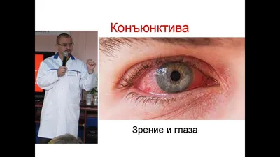 EyeQclinic/Ай-Кью Клиник - офтальмологическая клиника в Харькове - При  конъюнктивите поражается как конъюнктива век, так и конъюнктива глазного  яблока. Чаще всего бактерии попадают в глаза от грязных рук, при контакте с  инфекционными