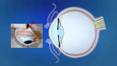 Лаборатория Экспресс ПЛЮС - Конъюнктивит - воспалительный процесс,  затрагивающий слизистую оболочку глаза (конъюнктивы). 🔹 🔹 🔹 🔹 🔹 🔹 🔹  🔹 🔹 🔹 🔹 🔹 🔹 Причины возникновения: 1. Аллергический конъюнктивит:  🔼аллерген