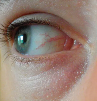 глаз. конъюнктива и склера стоковое изображение. изображение насчитывающей  зрачок - 220382497