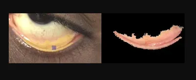 Лаборатория Экспресс ПЛЮС - 📌Конъюнктивит - воспалительный процесс,  затрагивающий слизистую оболочку глаза (конъюнктивы) ⠀ Причины  возникновения: ⠀ 1. Аллергический конъюнктивит: 🔼аллерген пыли; 🔼шерсти  животных; 🔼пыльцы растений; на фоне таких ...