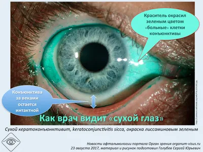 Анатомия: Соединительная оболочка глаза, tunica conjunctiva. Конъюктива  глаза