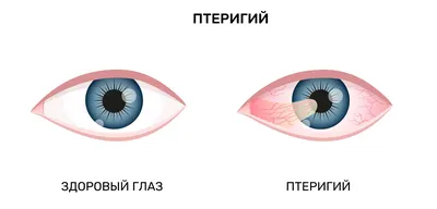 Меланоз глаза. Что делать? | Офтальмопластический хирург Топорков И.А. |  Дзен