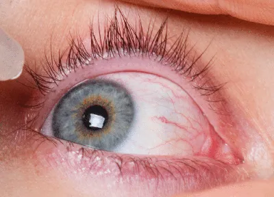 Киста конъюнктивы глаза: что это такое, как ее распознать и лечить | Первая  глазная клиника в Москве | Дзен