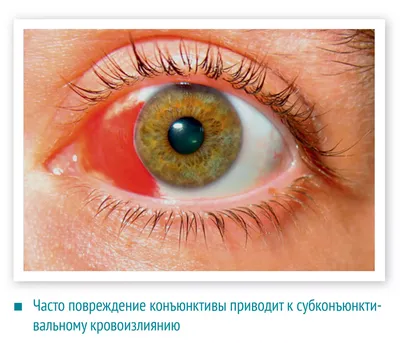 Синдром\" красного глаза\" без снижения зрительных функций - презентация  онлайн