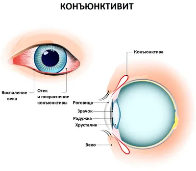 👁👁 Конъюнктивит: Виды, Проявления, Фото, Диагностика и Лечение 🩺