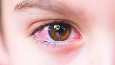 Конъюнктивит Или Раздражение Чувствительных Глаз Вид Крупным Планом На  Красные Глаза Человека — стоковые фотографии и другие картинки Воспалённый  глаз - iStock