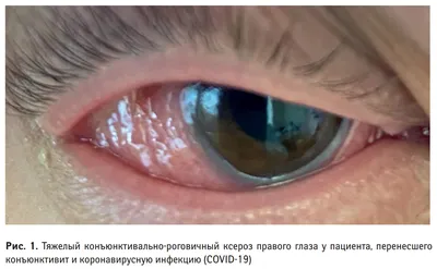 Безжалостно вытесняет»: новый штамм ковида «Арктур» поражает глаза — РБК