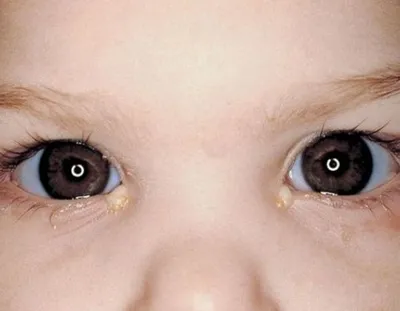 Конъюнктивит – офтальмологическое заболевание, при котором воспалительный  процесс распространяется на слизистую оболочку глаза. 🔹Характерные  симптомы... | By Платная скорая помощь \"Медэкспресс\" г. Алматы | Facebook