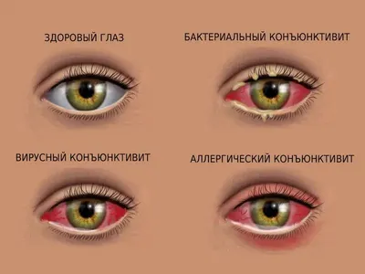 Конъюнктивит - глазная клиника Чакмак-Көз витреоретинальный центр г. Бишкек.