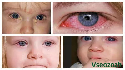Воспалительные заболевания глаз у детей: диагностика и лечение цена в  Екатеринбурге | Клиника микрохирургии \"Глаз\" им. С. Федорова